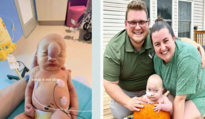 Мальчик, с мозговой грыжей на лбу, выжил и развивается вопреки прогнозам врачей